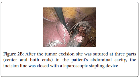 gastrointestinal-digestive-system-stapling-device