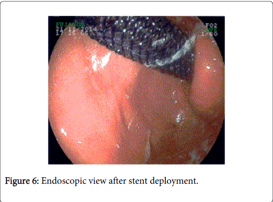 gastrointestinal-digestive-system-stent-deployment