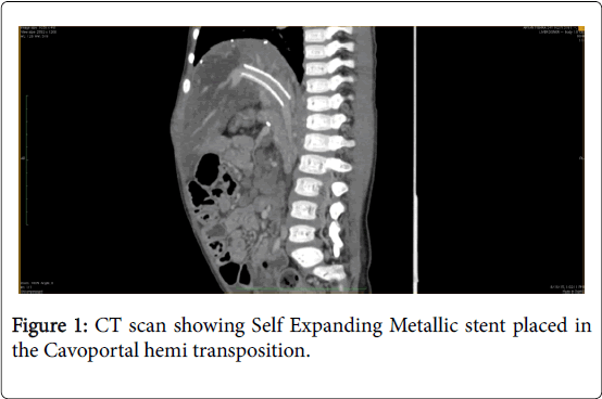 gastrointestinal-digestive-system-stent-placed