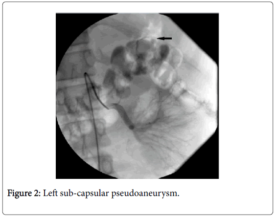 gastrointestinal-digestive-system-sub-capsular-pseudoaneurysm