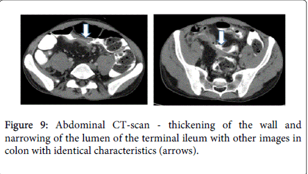 gastrointestinal-digestive-system-terminal-ileum