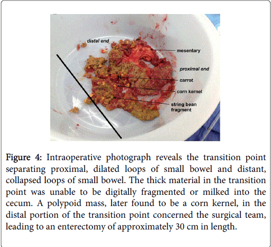 gastrointestinal-digestive-system-transition-point