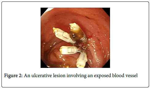 gastrointestinal-digestive-system-ulcerative-lesion
