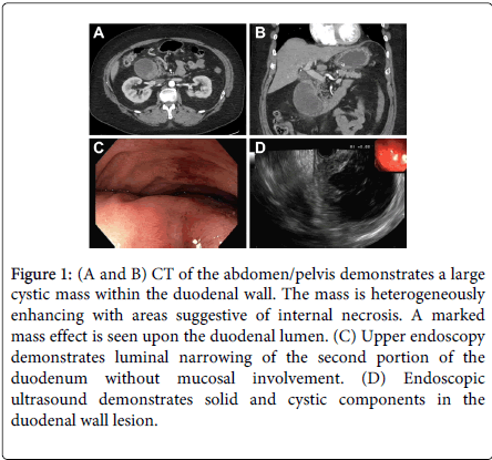 gastrointestinal-digestive-system-wall-lesion