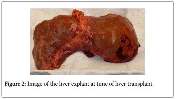 gastrointestinal-digestive-time-liver-transplant