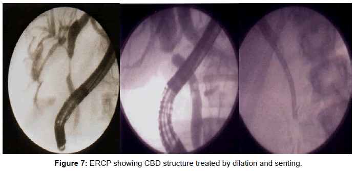 gastrointestinal-digestive-treated-dilation-senting