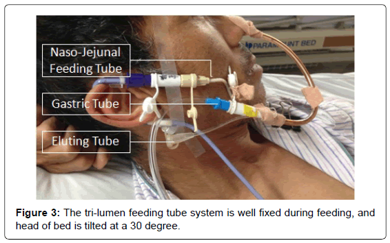 gastrointestinal-digestive-tri-lumen-feeding-tube