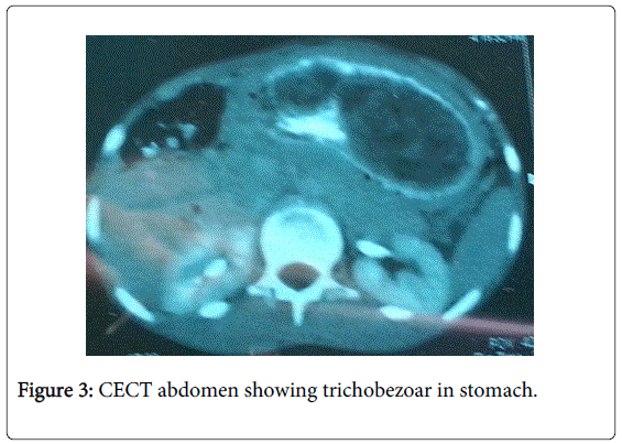gastrointestinal-digestive-trichobezoar-stomach