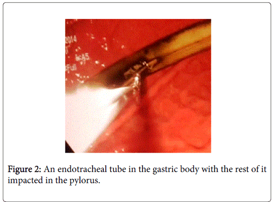 gastrointestinal-digestive-tube-gastric-body