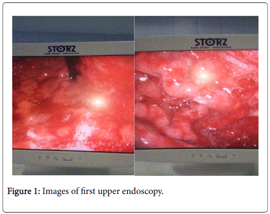 gastrointestinal-digestive-upper-endoscopy