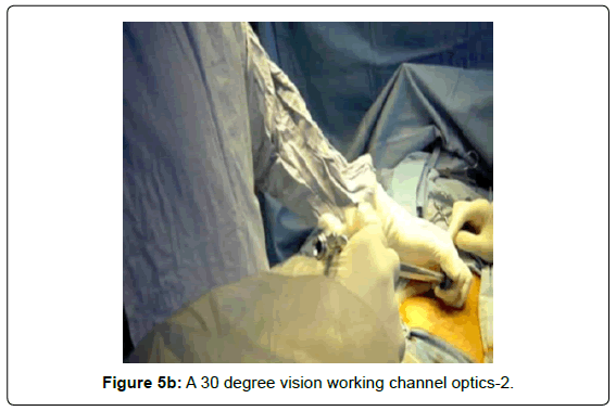 gastrointestinal-digestive-working-channel-optics