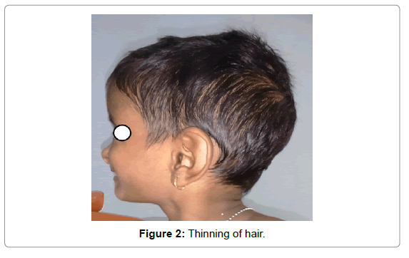 Hallermann Steriff Syndrome With Cutaneous Manifestations A