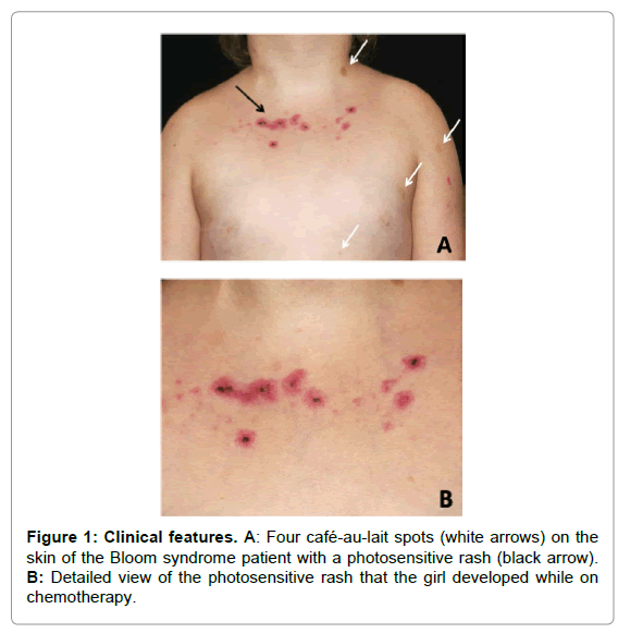 Acute lymphocytic leukemia information in philippines