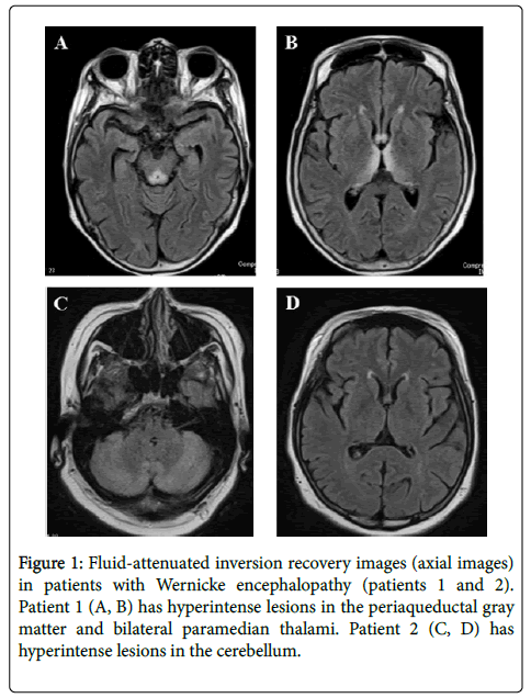 brain spect findings at the acute stage of disease in patients with wernicke encephalopathy