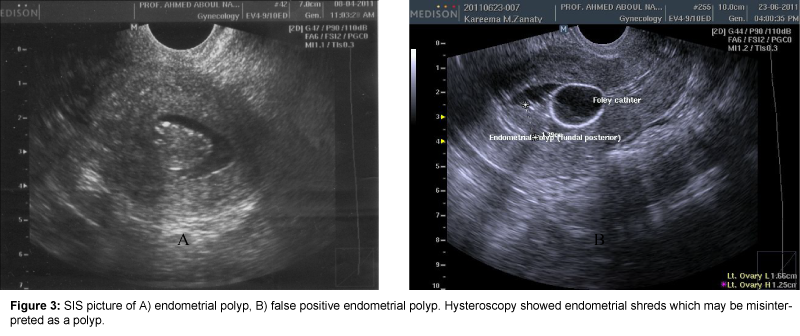 gynecologic-oncology-endometrial-polyp