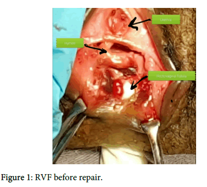 tear of vaginal fistula Self vagina exams