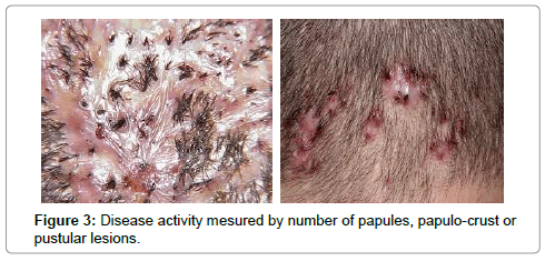  Homoeopathic approach in folliculitis decalvans- a rare but challenging disease