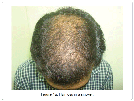 hair-therapy-transplantation-Hair-loss-smoker