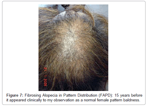 frontal fibrosing alopecia icd 10 code