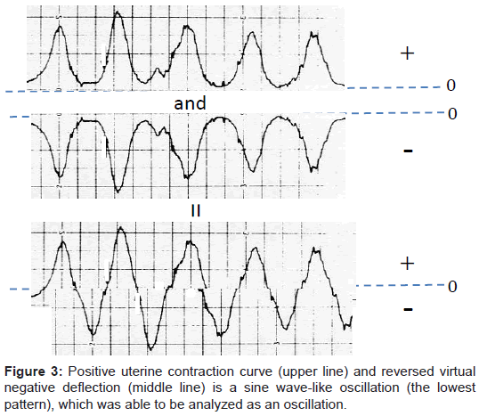 Labor Contractions Chart