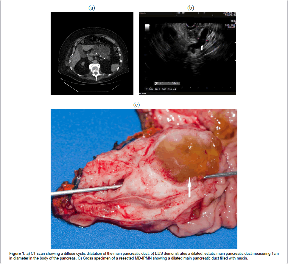Hepatology Gastrointestinal Cystic Dilatation Hepatology Gastrointestinal Cystic Dilatation
