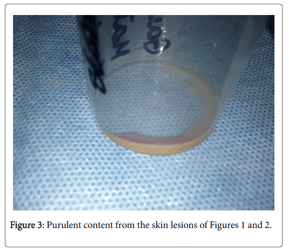 infectious-diseases-and-therapy-purulent-content