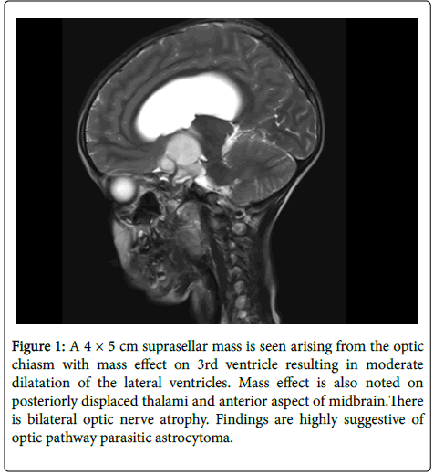 infectious-diseases-and-therapy-suprasellar-mass