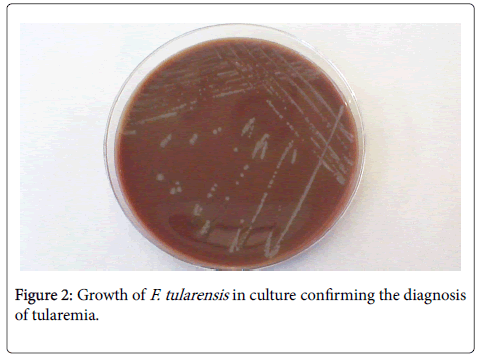 infectious-diseases-and-therapy-tularensis