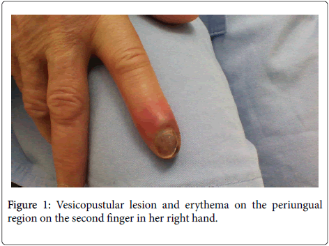 infectious-diseases-and-therapy-vesicopustular-lesion