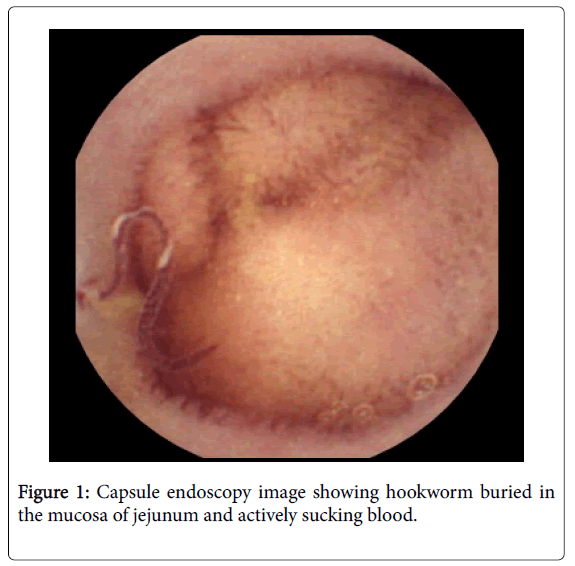 infectious-diseases-therapy-Capsule-endoscopy