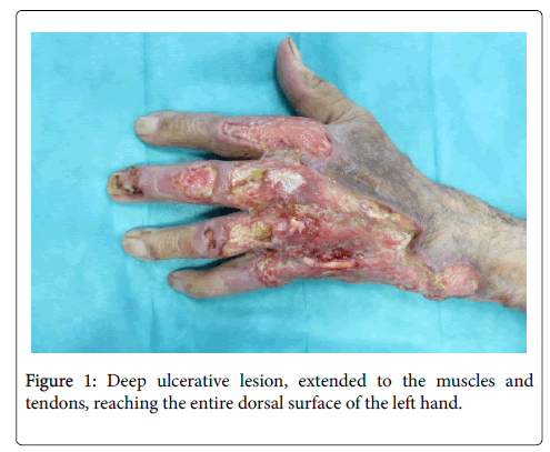 infectious-diseases-therapy-Deep-ulcerative
