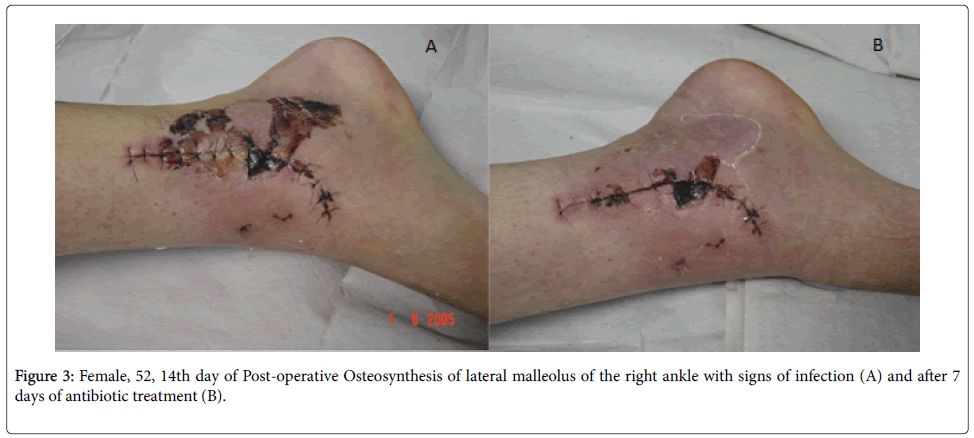 infectious-diseases-therapy-Post-operative-Osteosynthesis