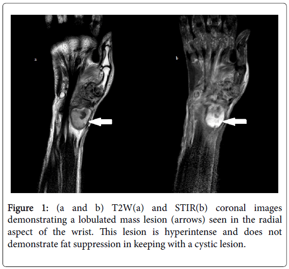 infectious-diseases-therapy-cystic-lesion