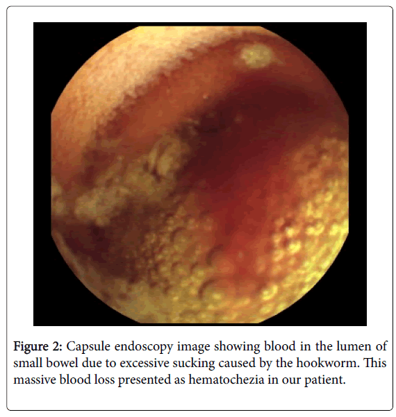 infectious-diseases-therapy-small-bowel