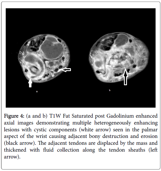 infectious-diseases-therapy-tendon-sheaths