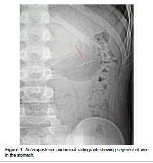 Case report: Orthodontic brace wire found in bowel