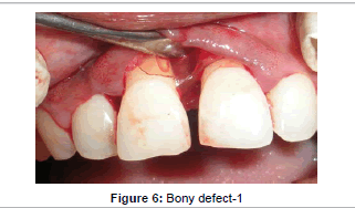 interdisciplinary-medicine-Bony-defect