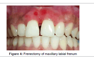 interdisciplinary-medicine-Frenectomy-maxillary