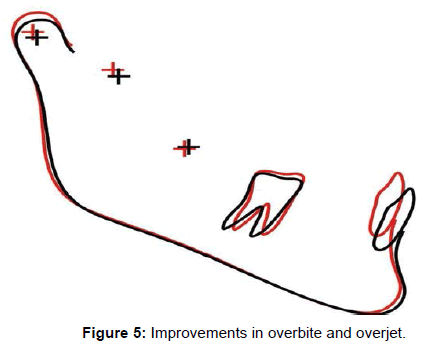 interdisciplinary-medicine-Improvements-overbite