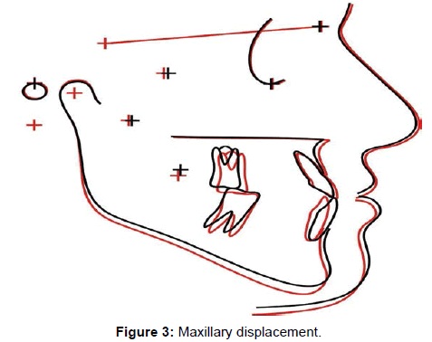 interdisciplinary-medicine-Maxillary-displacement