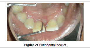 interdisciplinary-medicine-Periodontal-pocket