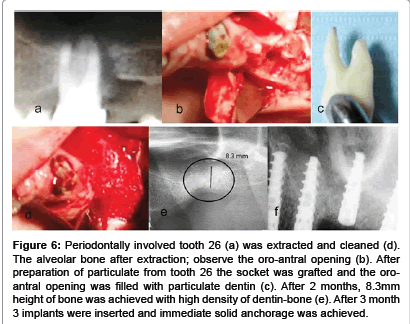 interdisciplinary-medicine-bone-after-extraction