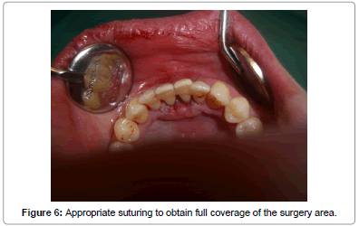 interdisciplinary-medicine-dental-science-Appropriate-suturing-obtain-coverage