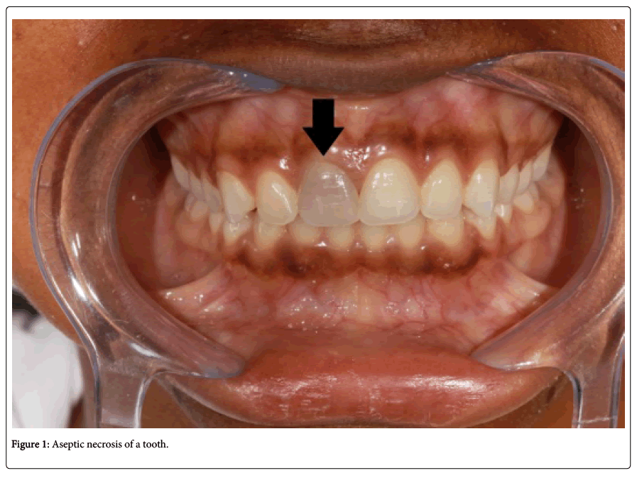 interdisciplinary-medicine-dental-science-Aseptic-necrosis-tooth
