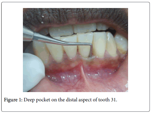 interdisciplinary-medicine-dental-science-Deep-pocket