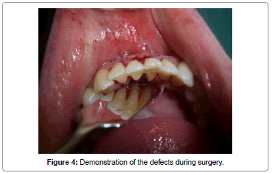 Tongue piercing teeth sales