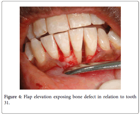 interdisciplinary-medicine-dental-science-Flap-elevation