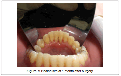 interdisciplinary-medicine-dental-science-Healed-site-1-month-after-surgery