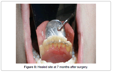 interdisciplinary-medicine-dental-science-Healed-site-7-months-after-surgery