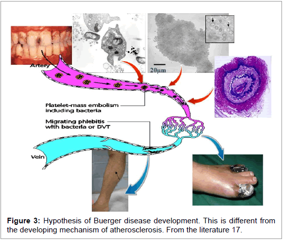 interdisciplinary-medicine-dental-science-Hypothesis-Buerger-disease-development